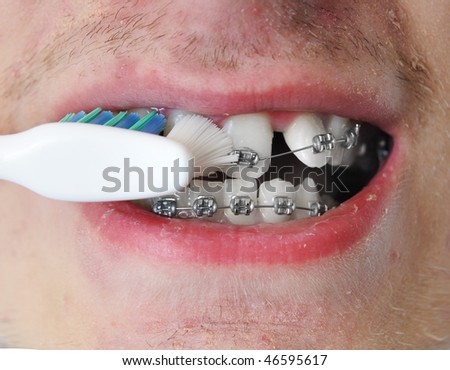 Young man brushes his pure white clean teeth. His teeth are crooked and he has braces on. This is a closeup.