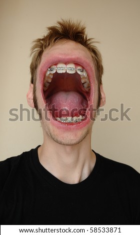 A huge screaming mouth with braces on his teeth, yelling his face off.