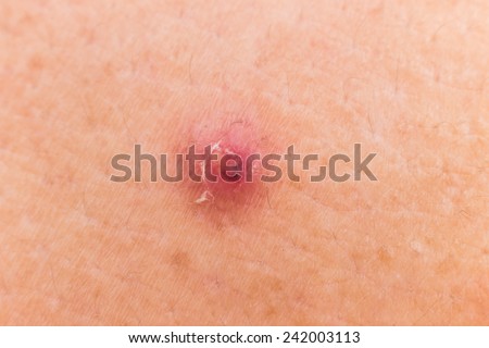 Closeup of a blemish on the skin of the shoulder