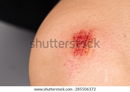 Closely on bloody bruise wound on the knee