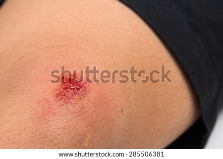 Close up on bloody bruise wound on the knee