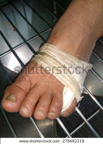 Gauze bandage the foot,treating patients with foot ulcers