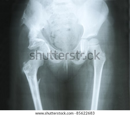 X-ray of the pelvis and thigh bones
