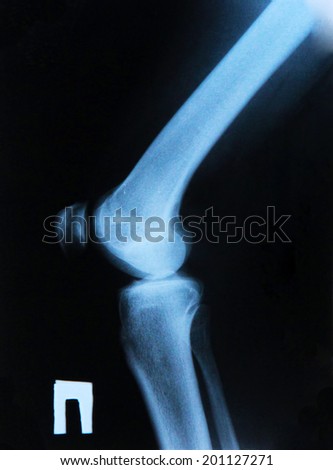 X-Ray image of the human knee