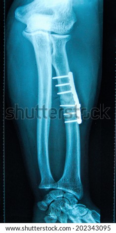 X-Ray of broken tibia with screw fixation surgery (intramedullary nail)