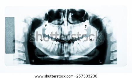 Teeth x-ray on white background
