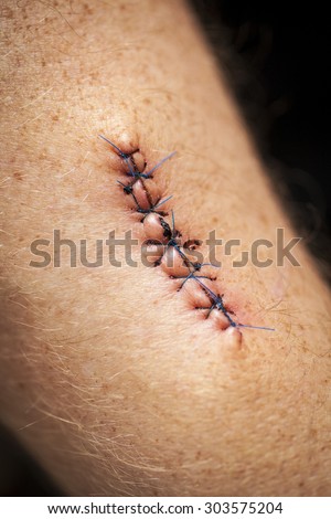 Stitched up skin after an operation to remove a cancerous mole