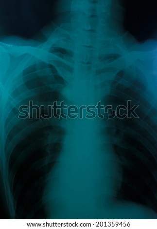 Film chest x-ray PA upright : show normal human\'s chest