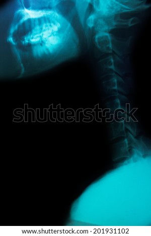 radio graphs skull and cervical vertebra detail