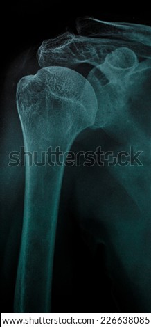 X-ray anterior shoulder dislocation