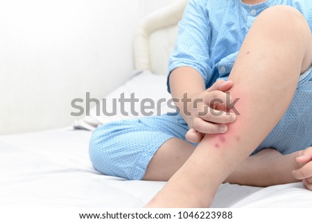 Hand scratching ,legs of fat boy with swelling spot ,sore and scar from mosquitoes bite allergy, Health care concept