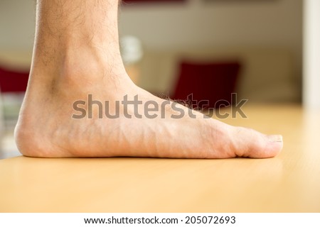 An advanced flatfoot - medical condition