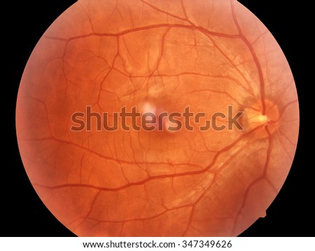 Human eye anatomy, retina, optic disc artery and vein (Right), optic nerve normal