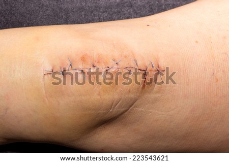 A stitched wound after a surgical procedure on the knee cap
