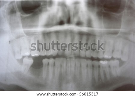 Dental X-Ray Of Man'S Teeth Showing Missing Tooth On Photographic ... Dental X-Ray Of Man'S Teeth Showing Missing Tooth On Photographic ...
