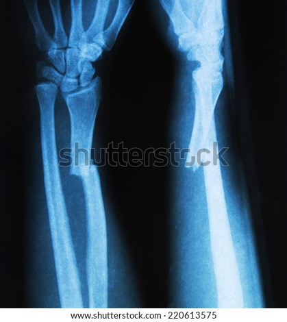 x ray Image of  legs Bone fracture