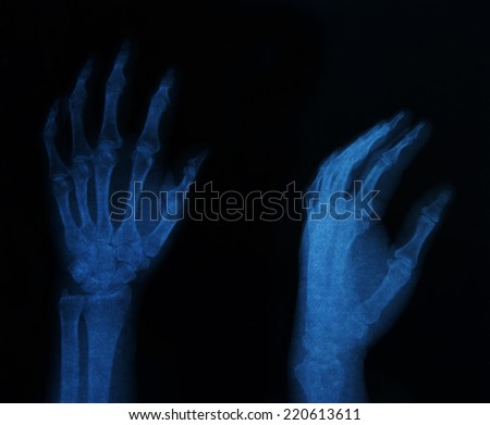 x ray Image of both human hands