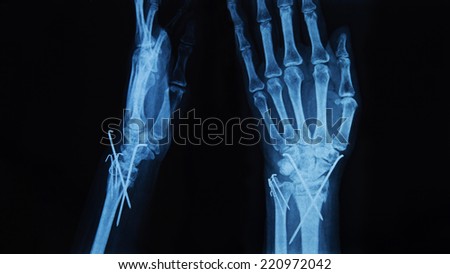 x ray Image of  human hands ,  wire to connect the joints.