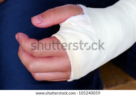Broken hand in plaster cast with bandages, red, swollen fingers after an operation to fix the bones in place.