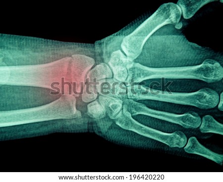 film x-ray wrist show fracture distal radius