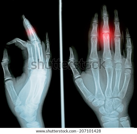 Film X-ray Hand Ap And Lateral - Stock Image - Everypixel