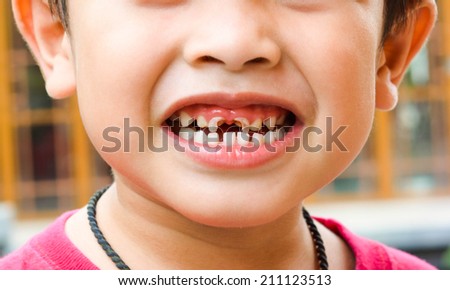 boy with a teeth broken and rotten