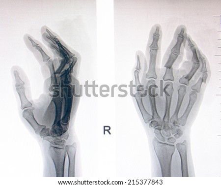 injury of hand and finger x-rays image on the computer monitor