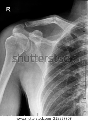 Film X-ray show  fracture clavicle