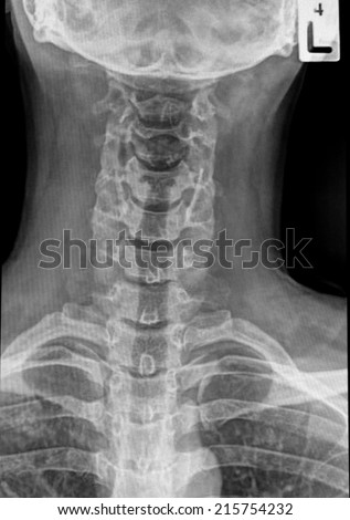 X-ray of human cervical spine