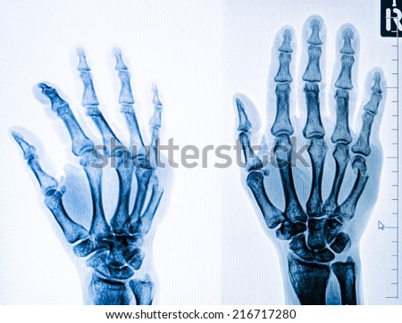 injury of hand and finger x-rays image on the computer monitor