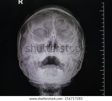 x-ray image of the painful or injury skull , head injury