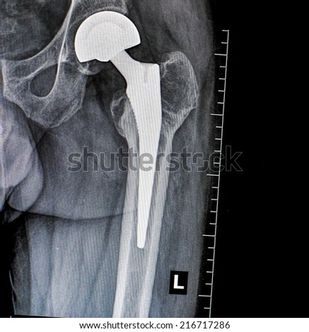 imaging Xray of permanent total hip arthroplasty