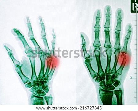 injury of hand and finger x-rays image