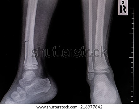 Broken leg x-rays image