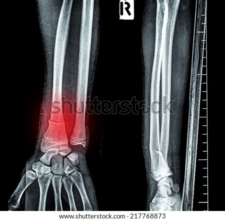 x-ray image show fracture bone