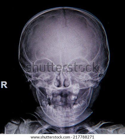 front face skull x-ray image