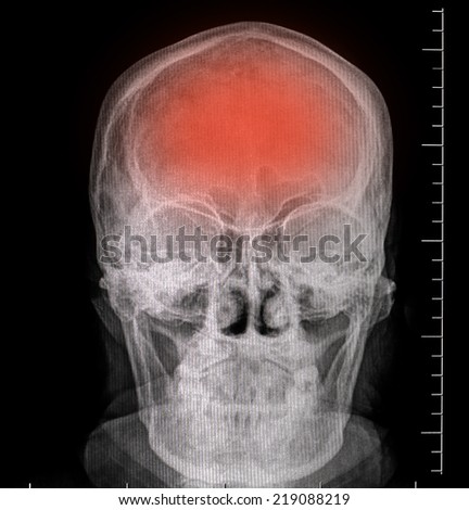front face skull x-ray