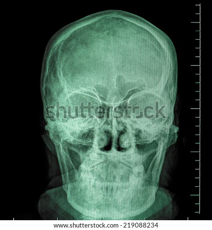front face skull x-ray