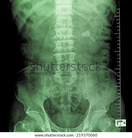 x ray for kidney stones