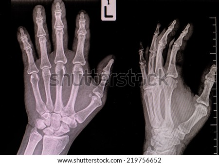 hand and finger x-rays image