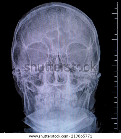 front face skull x-ray image