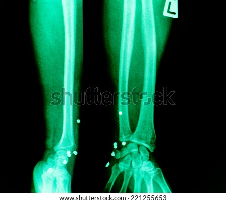 X ray images, bullets embedded in the wrist