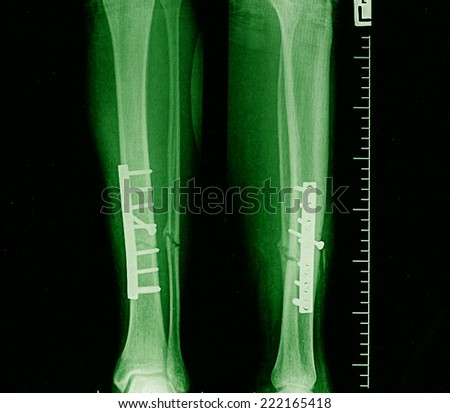 leg fracture with displacement, small and large tibia bone. X-ray