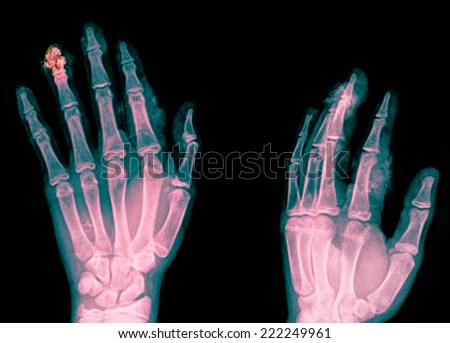 xray of a hand with broken finger