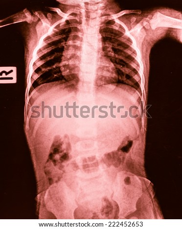 Film chest and abdomen of an infant