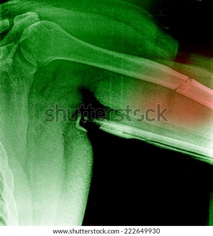 Broken arm / Many others X-ray images in my portfolio.