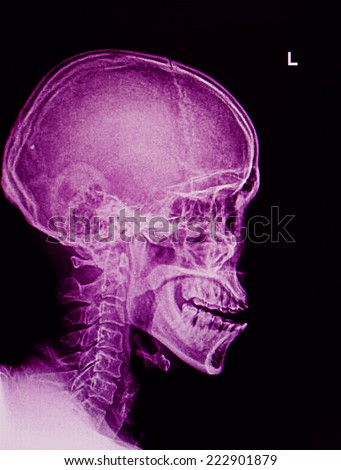 Film x-ray Skull lateral : show normal human\'s skull