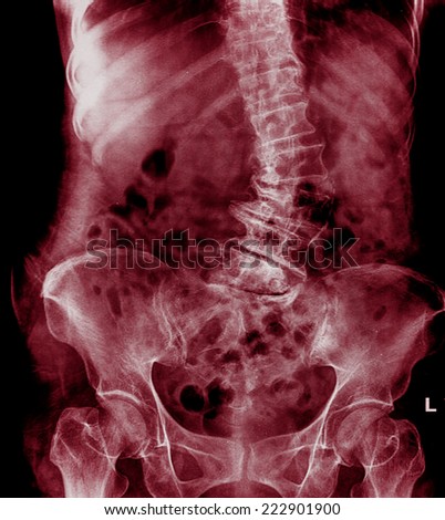 Scoliosis film x-ray lumbar spine AP : show spine bend in old aged patient