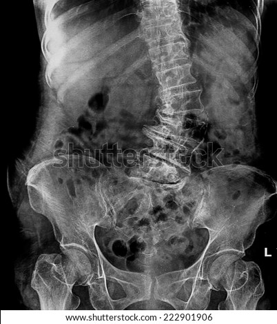 Scoliosis film x-ray lumbar spine AP : show spine bend in old aged patient