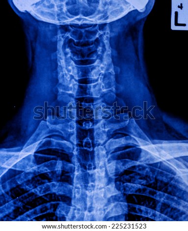 x-ray of neck, painful